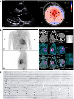 Case Report: Transthyretin Glu54Leu—a rare mutation with predominant cardiac phenotype